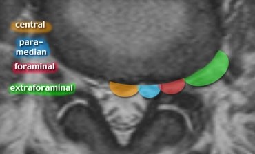Axial localisation of herniated discs